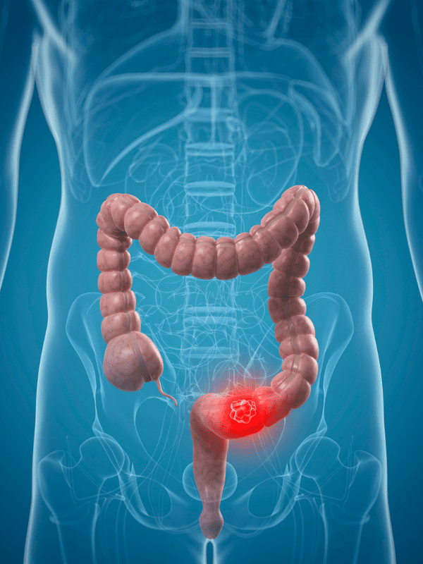 Cancer de colon y recto en veracruz