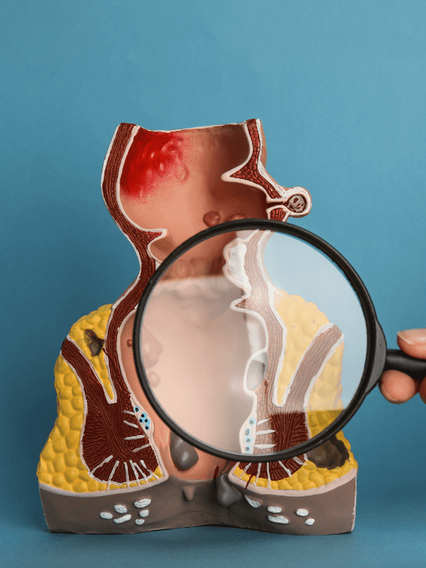 hemorroides en veracruz