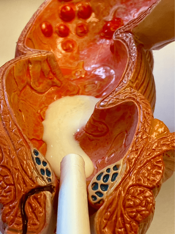 prolapso rectal  en veracruz