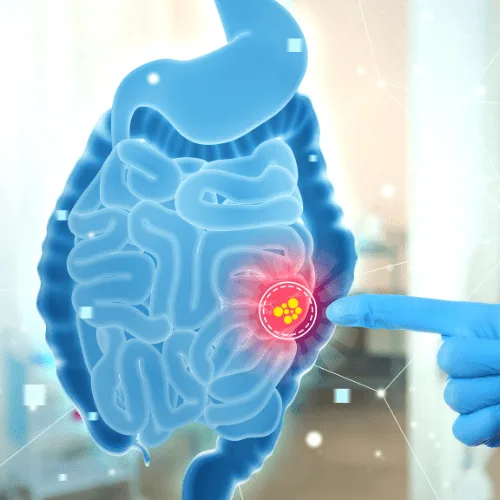 ¿Qué médico trata el cáncer rectal?